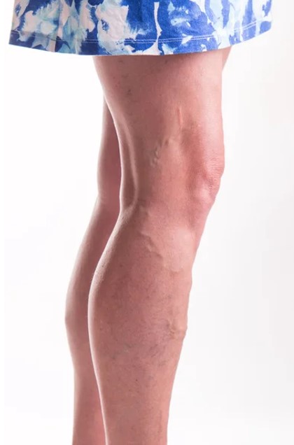 Drenaje linfático Madrid. Tratamiento patologia vascular